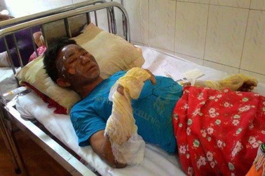 Nổ khí gas, 10 người đang ăn cơm bị bỏng nặng