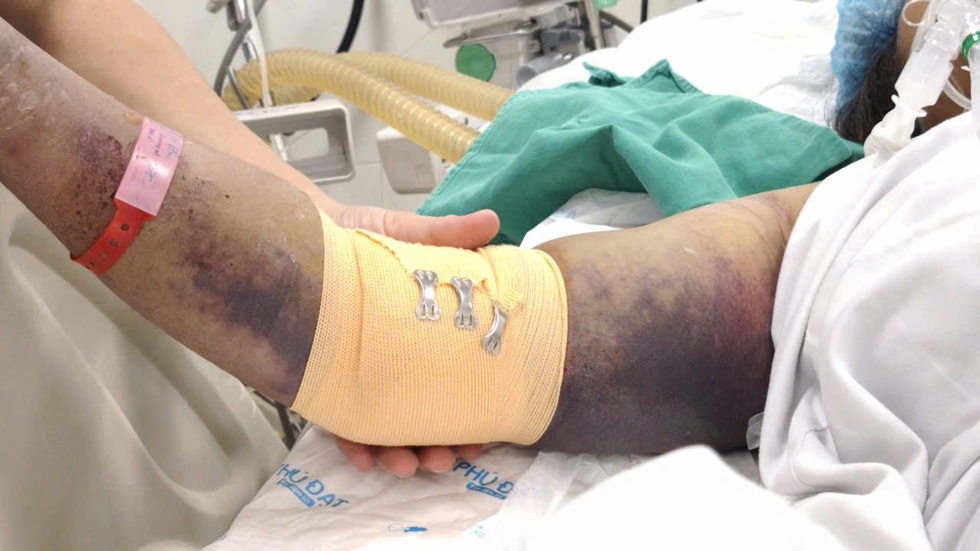 Ngỡ chỉ là cơn sốt nhẹ, người đàn ông rơi vào sốc sốt xuất huyết nguy kịch - 7 Ngỡ chỉ là cơn sốt nhẹ, người đàn ông rơi vào sốc sốt xuất huyết nguy kịch - 7