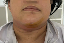 Cô gái mới 32 tuổi đã bị ung thư: Cảnh giác khi thấy nuốt nghẹn, khàn tiếng