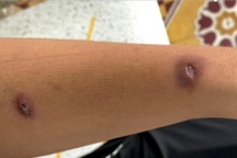 Vì một con tôm, chàng trai mắc căn bệnh gây loét da chảy mủ kỳ lạ