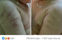 Liên tiếp 2 trẻ mầm non bị bạo hành, công an vào cuộc