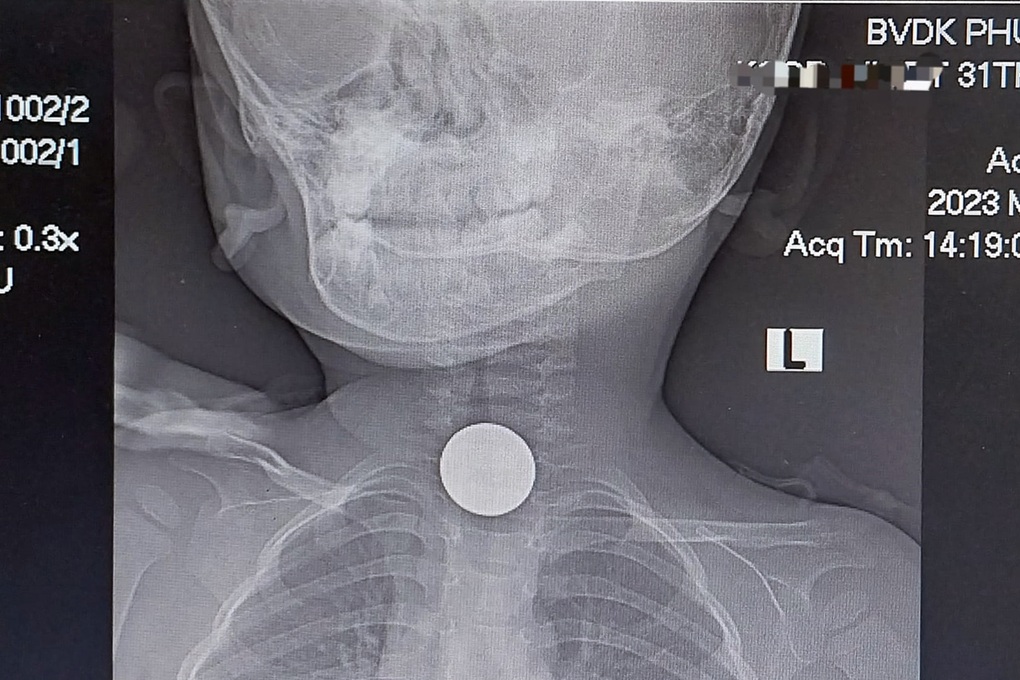 Cứu bé trai 3 tuổi nuốt tiền xu 500 đồng vào cổ họng - 1