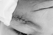 Bé trai 10 tuổi ở TPHCM bị bạn bắn đạn súng hơi găm vào xương sọ