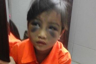 Lào Cai: Sẽ xử lý nghiêm khắc cô giáo đánh bé gái tím mặt