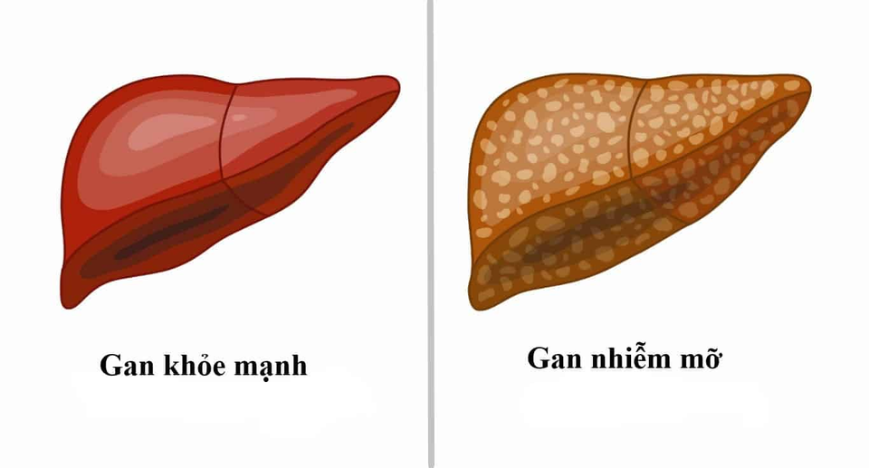Giải pháp điều trị gan nhiễm mỡ giúp cải thiện tình trạng - 1 Giải pháp điều trị gan nhiễm mỡ giúp cải thiện tình trạng - 1
