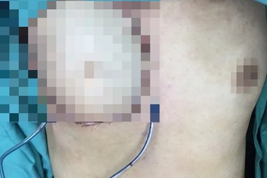 Ngực phải nữ bệnh nhân lở loét, chảy mủ vì đắp thuốc nam chữa ung thư vú