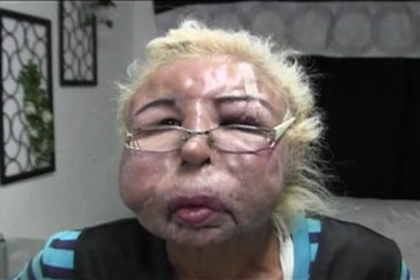 Gương mặt biến dạng vì tự tiêm dầu dưỡng ẩm