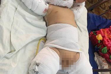 Bé trai 1 tháng tuổi bị người dượng thiêu sống đã tử vong