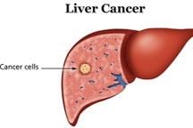 Bạn nên tầm soát ung thư gan khi thấy những dấu hiệu này