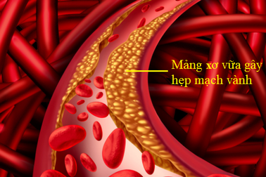Sống khỏe với tắc hẹp mạch vành không khó, nếu bạn hiểu đúng bệnh