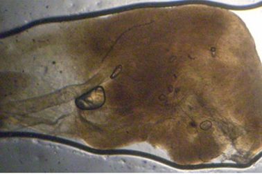 Hãi hùng sán nhái chui vào phổi