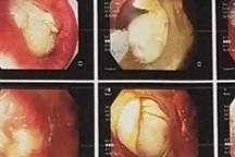 Người phụ nữ tử vong sau hóc thịt trâu 5 ngày