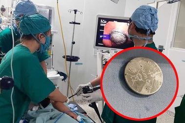 Bé gái 16 tháng tuổi cấp cứu vì nuốt viên pin trong đồ chơi