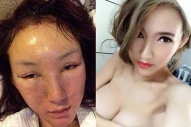 Thêm một thảm họa phẫu thuật thẩm mỹ của Trung Quốc 