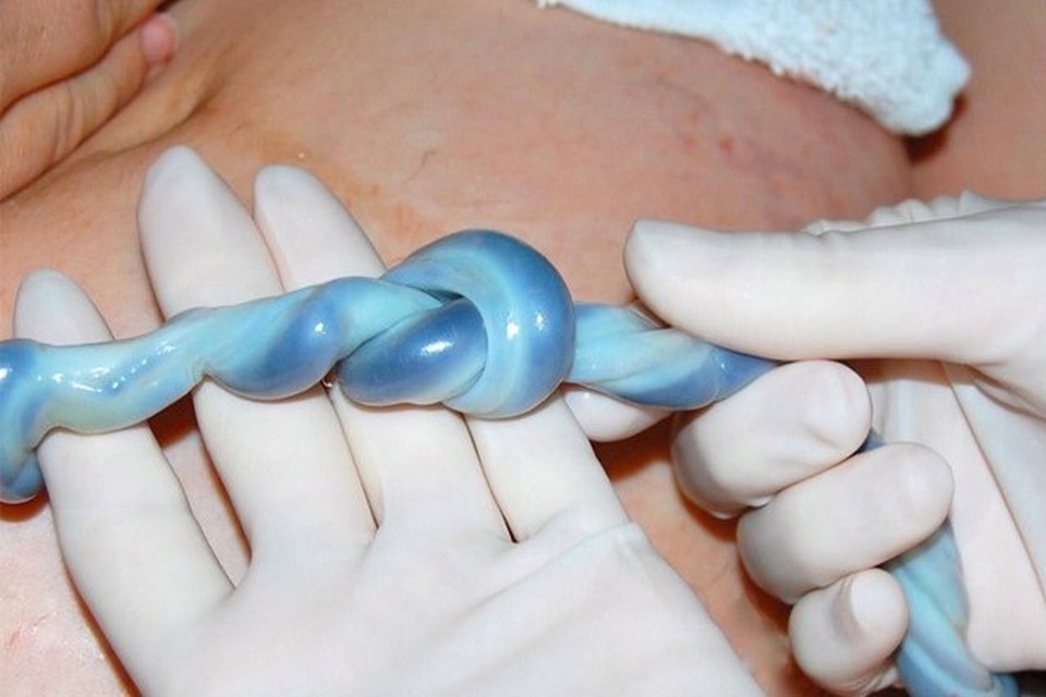 Dây rốn bị thắt nút, bé sơ sinh may mắn thoát chết trong gang tấc - 2 Dây rốn bị thắt nút, bé sơ sinh may mắn thoát chết trong gang tấc - 2