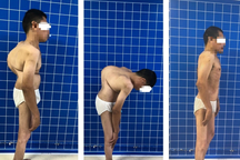 Hy hữu: Người đàn ông nhiều năm mang "mai rùa" vì bệnh cột sống