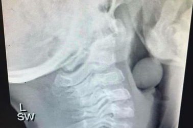 Hình ảnh đáng sợ khi trẻ bị hóc nho