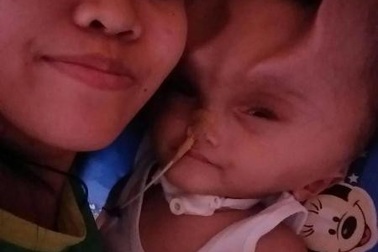 Em bé 1 tuổi mang cặp sừng quỷ dữ sau ca phẫu thuật bất thành