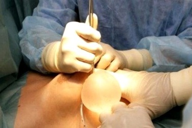 Phải cắt “đôi gò bồng đảo” vì di chứng sau bơm silicon