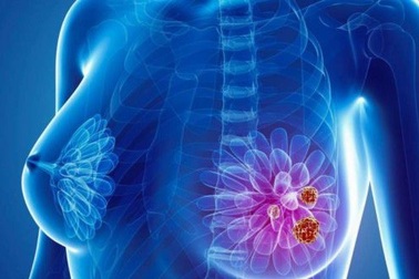 Yếu tố nguy cơ gây ung thư vú