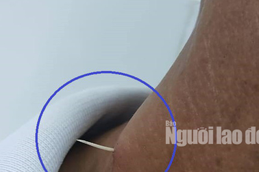 Hãi hùng xương cá đâm xuyên thực quản, lộ ra ngoài da