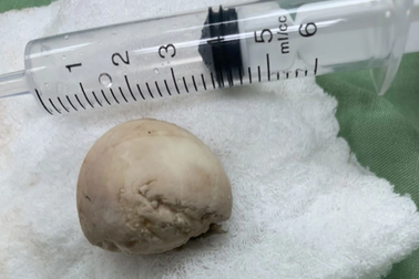 Cấp cứu sau khi ăn trứng vịt lộn vì thủ phạm không ngờ