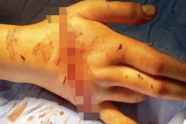 Nối thành công bàn tay bị đứt lìa do cưa máy cắt