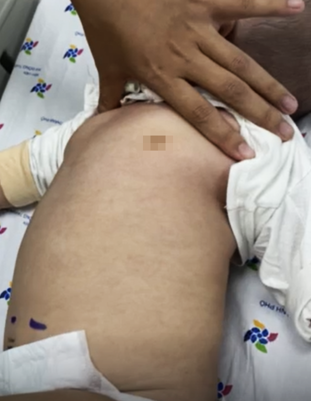 Bé trai nhiễm sốt xuất huyết nguy kịch nhưng 2 nơi chẩn đoán tay chân miệng - 2 Bé trai nhiễm sốt xuất huyết nguy kịch nhưng 2 nơi chẩn đoán tay chân miệng - 2