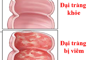 Giải toả nỗi lo viêm đại tràng