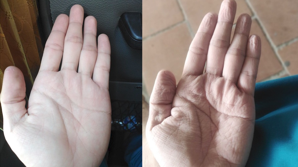 Những đôi bàn tay biến dạng tại chảo lửa Covid-19 ở Bắc Giang - 1 Những đôi bàn tay biến dạng tại chảo lửa Covid-19 ở Bắc Giang - 1