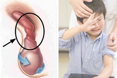 Cảnh giác cao độ với xoắn tinh hoàn