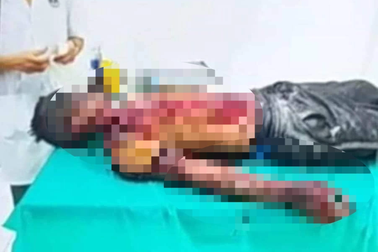 Nổ bình khí oxy, thợ hàn xì bị bỏng, thương tích nặng