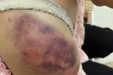 Bé gái 12 tuổi nghi bị bà nội hành hạ, may mắn không gãy xương