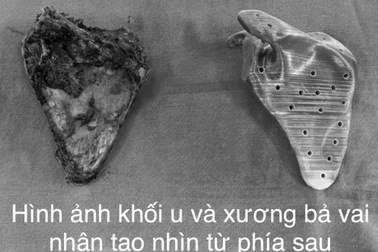 Bé trai 12 tuổi phát hiện mắc ung thư chỉ từ cơn đau âm ỉ ở vai