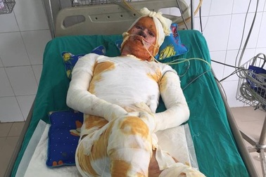 Sức khỏe của 3 người trong gia đình bị bỏng đã tốt hơn