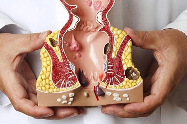 Những lưu ý khi bị bệnh trĩ bạn cần biết