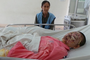 Thai nhi nguy kịch trong bụng người mẹ bị bỏng nặng