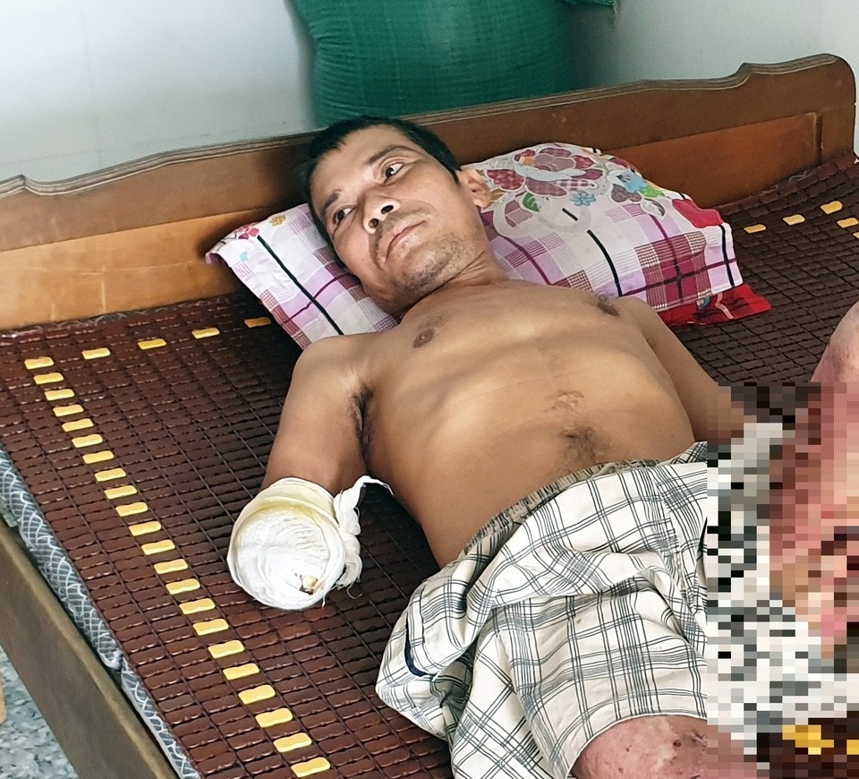 Xót xa người đàn ông đi kiếm cơm nuôi con bị phóng điện mất đôi bàn tay - 1 Xót xa người đàn ông đi kiếm cơm nuôi con bị phóng điện mất đôi bàn tay - 1