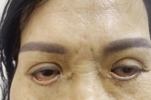 Mắt trợn ngược, sẹo chi chít như "vá xe" sau cắt mí