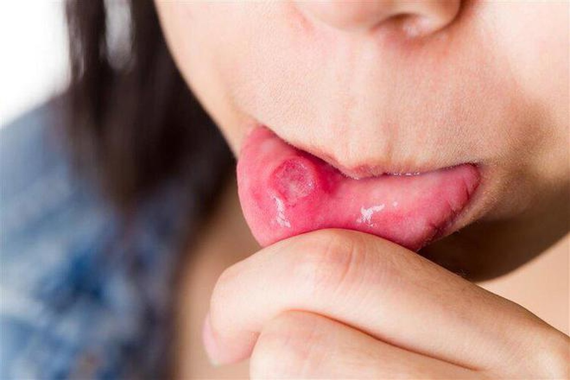 Vết loét tưởng nhiệt miệng đi khám mới biết ung thư - 1 Vết loét tưởng nhiệt miệng đi khám mới biết ung thư - 1
