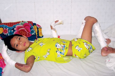 Cám cảnh gia đình cháu bé bị anh họ thiêu đốt