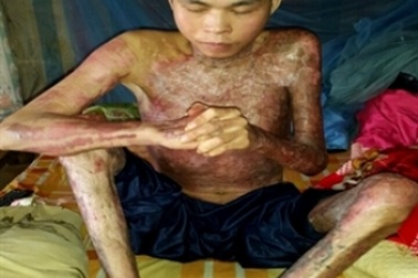"Đổi đời" sau 7 lần phẫu thuật di chứng do bỏng lửa xăng