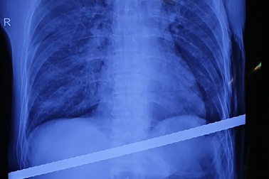 Kỳ tích cứu sống người đàn ông bị thanh sắt đâm xuyên người