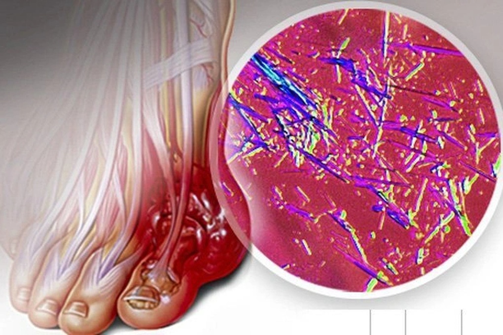 Cao thủ hạ axit uric rẻ bèo ở chợ Việt - 1