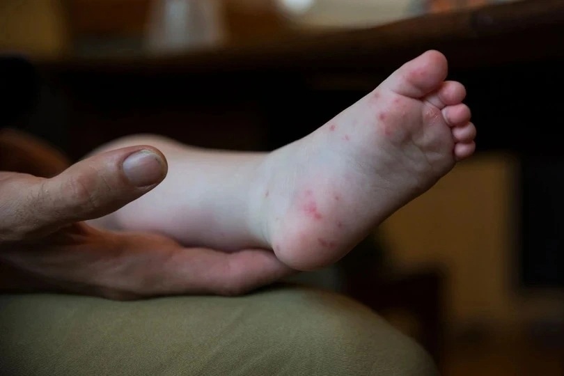 Việt Nam thử nghiệm vaccine tay chân miệng hiệu quả hơn 99% - 2