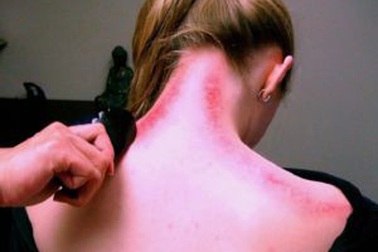 Cạo gió thế nào cho đúng?