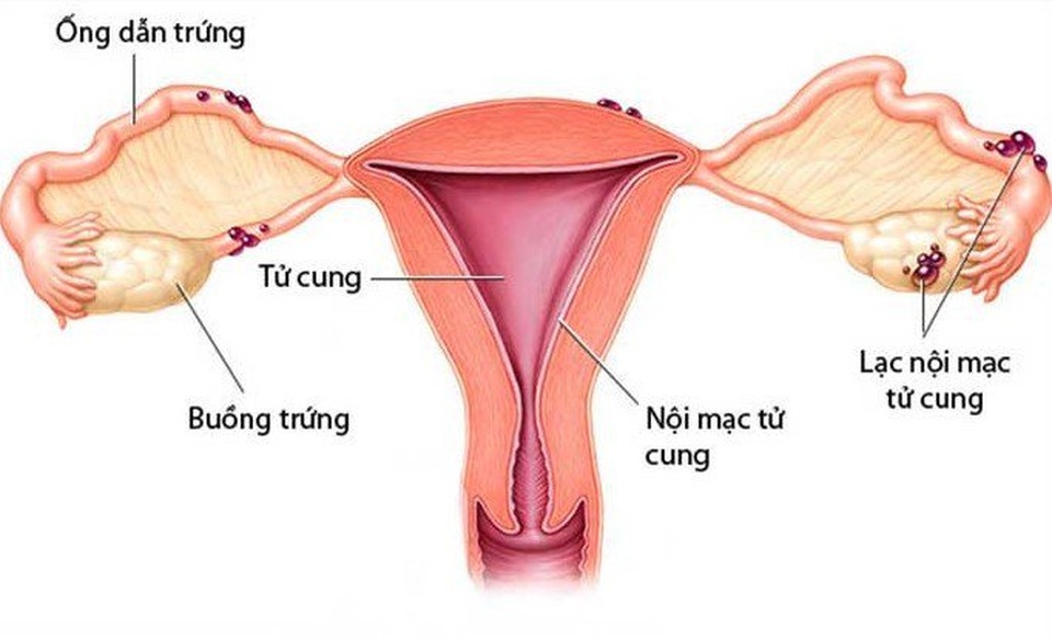 Tại sao nên dùng Phụ Lạc Cao EX để phòng ngừa lạc nội mạc tử cung tái phát sau phẫu thuật? - 1 Tại sao nên dùng Phụ Lạc Cao EX để phòng ngừa lạc nội mạc tử cung tái phát sau phẫu thuật? - 1
