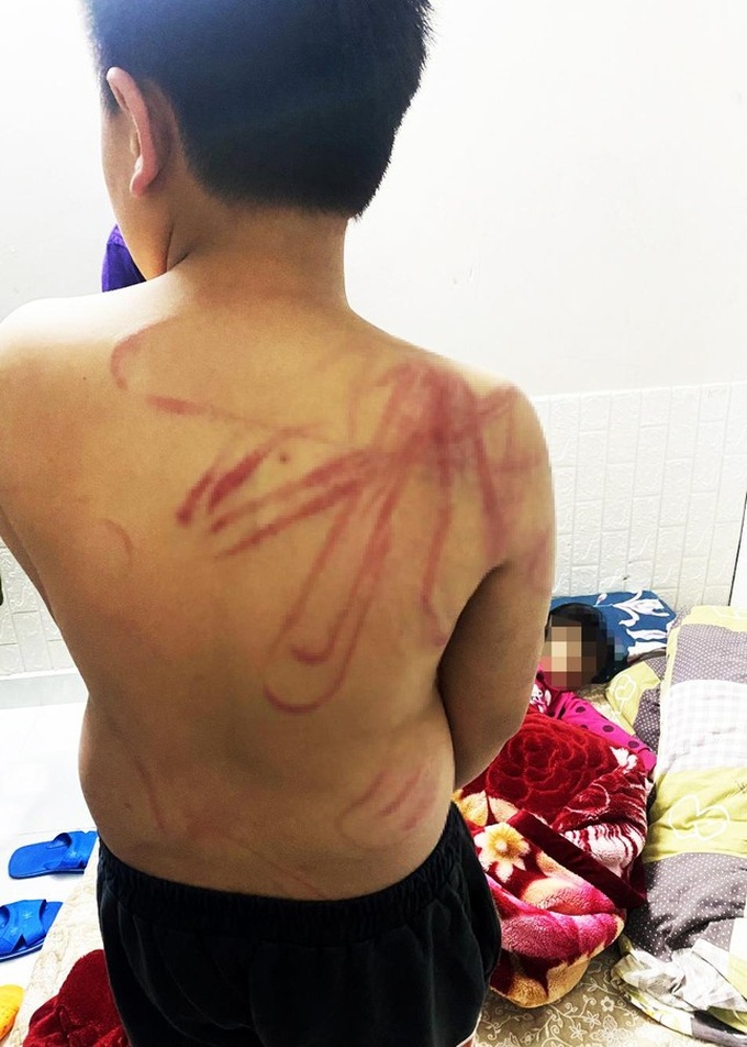 Vết thương trên người cháu bé.