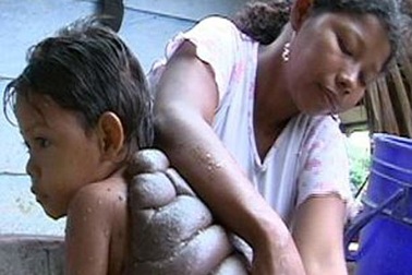 Cậu bé có vết bớt "khủng" như mai rùa