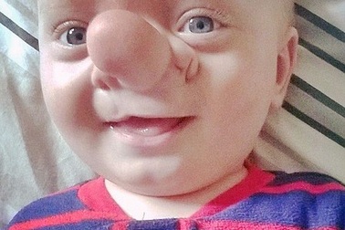 Em bé có não mọc ở mũi